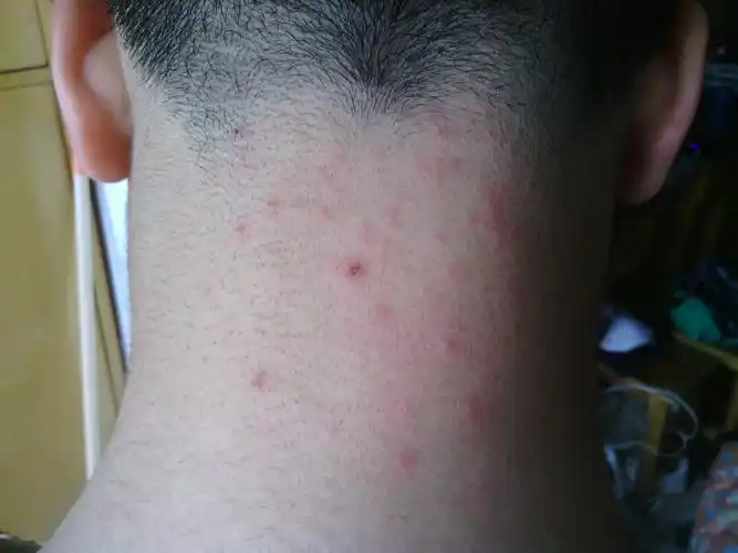 后颈处有红色皮炎?这是什么东西?怎么治?有图