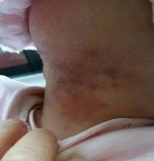 婴儿螳螂嘴正常吗(马牙螳螂嘴鹤咬痕)(8)