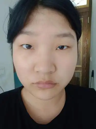 我的眼睛太小需要割吗?