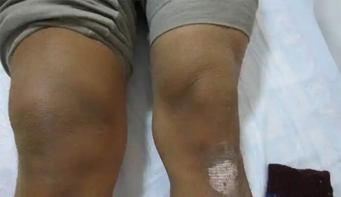 "积液"是什么,我该怎么办?