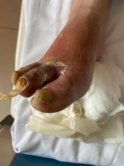 全足红肿局部窦道,皮肤破溃,红肿明显,感染严重;骨髓炎形成术前cta示