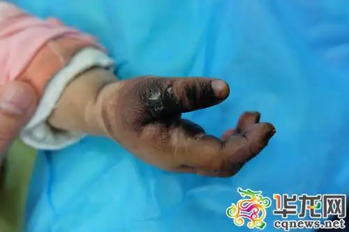 3岁娃误把电动车当摇摇车 往充电插座投币被烧伤