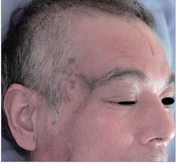 患者右侧颞部存在一凹陷性空洞