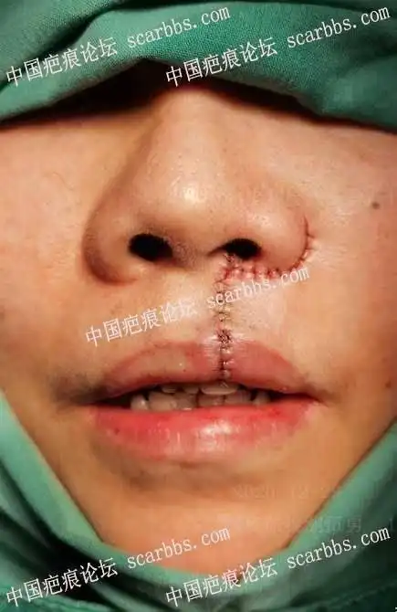 唇裂术后修复半年对比-疤痕论坛