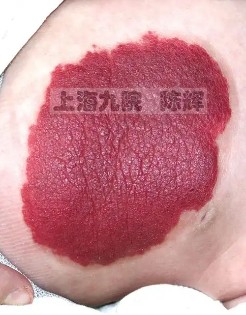 走进"婴幼儿血管瘤"的世界——高清大图下的细节辨识和诊疗精要