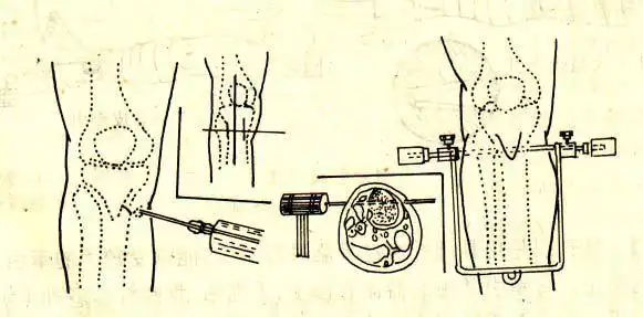 穿刺部位:胫骨结节顶端下,后各2㎝;由外向内进针,防止伤及腓总神经.