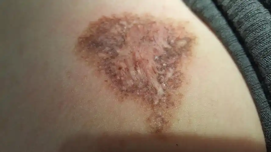 表面不平,有小毛发,褐色斑片中有绿豆大小点状黑色斑点,稍突出皮肤.