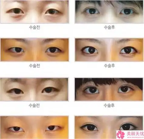 鹤壁隐性斜视眼矫正费用大致需要多少钱