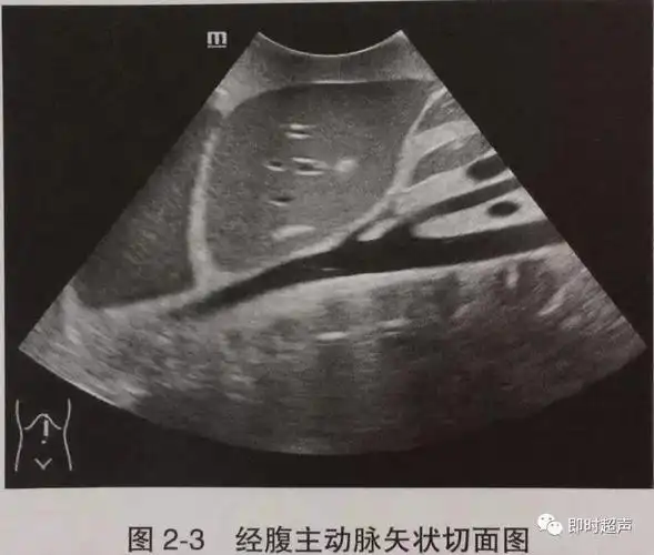 该扫查切面显示肝左叶结构及其深部的大血管,获得经第一肝门横断面图