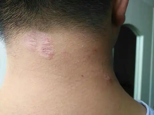 100种癣对照图 各种癣的症状图片大全