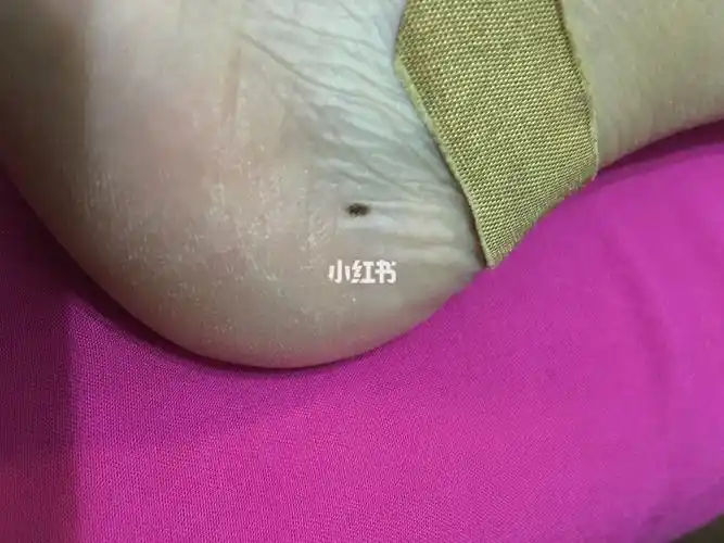 想问下这个脚后跟上的黑点(平的,不凸)需要去看医生不?