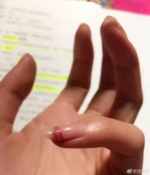 女生受伤的手图片