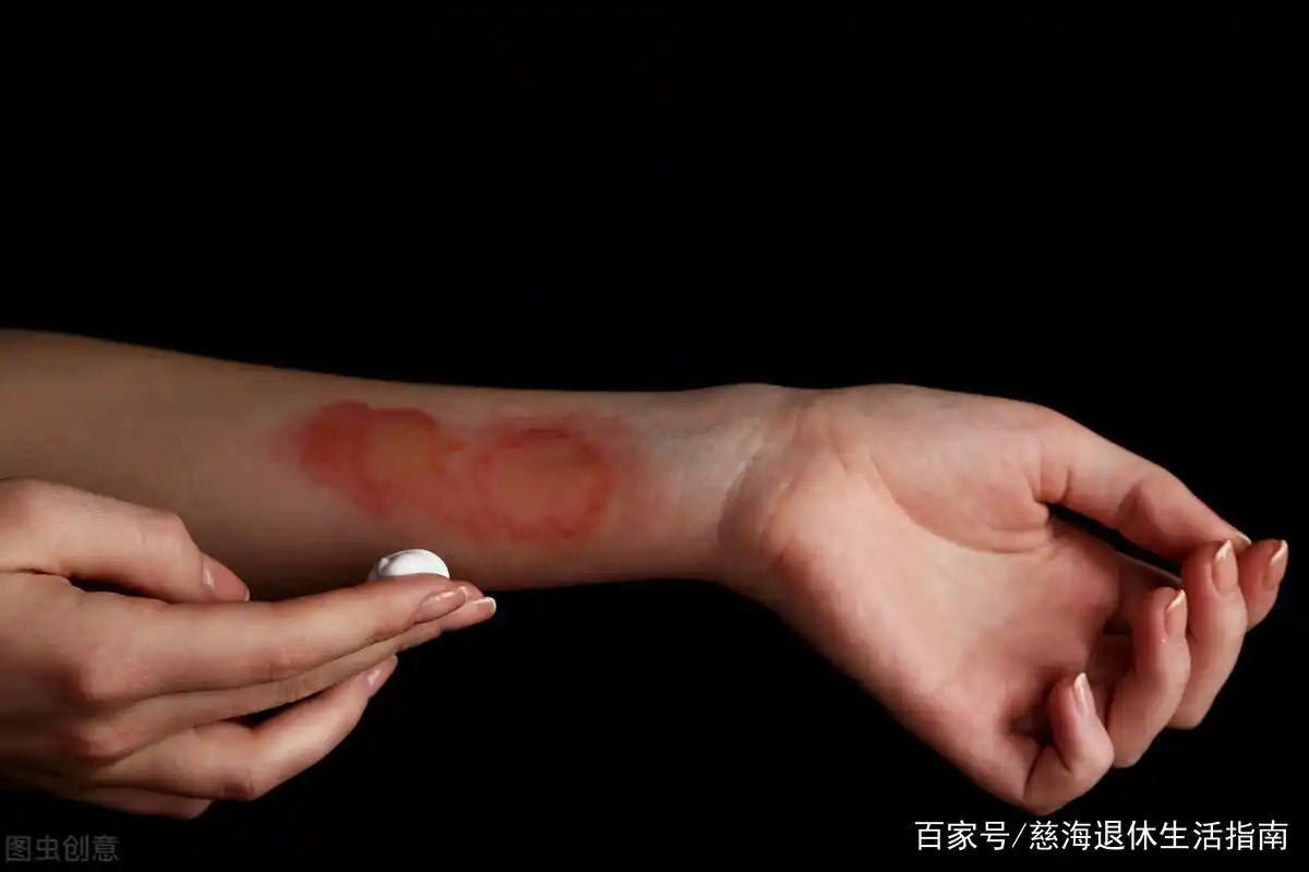 暖宝宝使用不当,会导致低温烫伤!