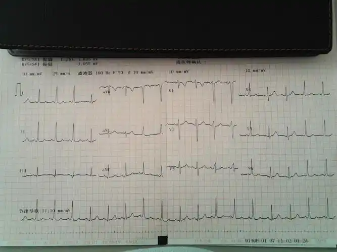 间歇性的wpw - 心电图脑电图专业讨论版 - 爱爱医医学论坛