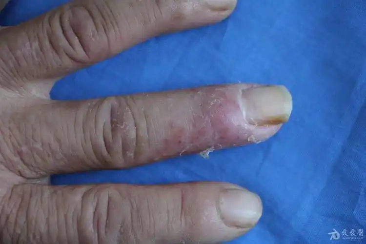 2016年皮肤版有奖病例猜答1答案连续性肢端皮炎