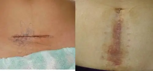 剖腹产通常会给孕妇留下难以磨灭的疤痕.