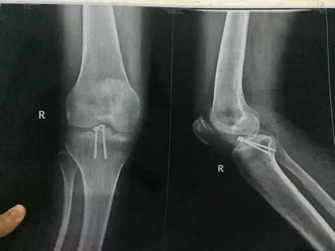 右腿膝盖髁间棘撕脱骨折,去年做了微创手术,膝盖打了三个小洞,打了两