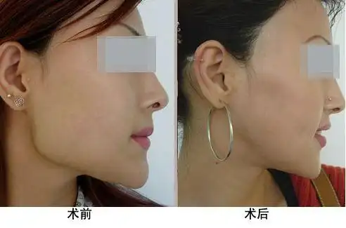 削骨磨骨有什么后遗症脸颊削骨有什么后遗症削骨惨痛经历