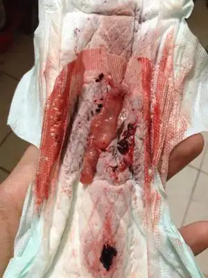 医院人流了,我本身不想要这个孩子,今天排除了这个,这是自然流产了吗