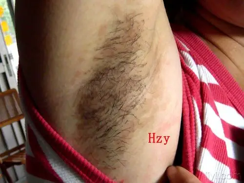 两腋窝及剑突部褐色斑二年