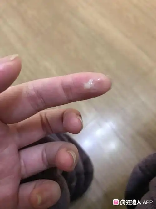 俏丽妈 酸奶白带是什么样子啊?我是这个样子