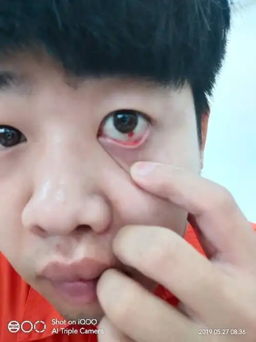 眼睛,眼白有血块,怎么回事呢?