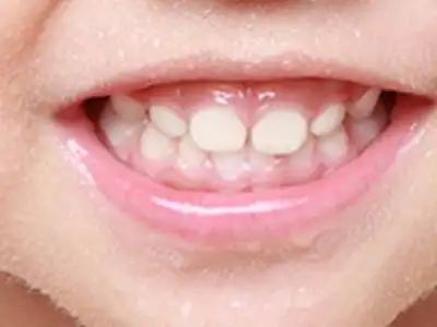 儿童牙齿保健 如何保护幼儿牙齿