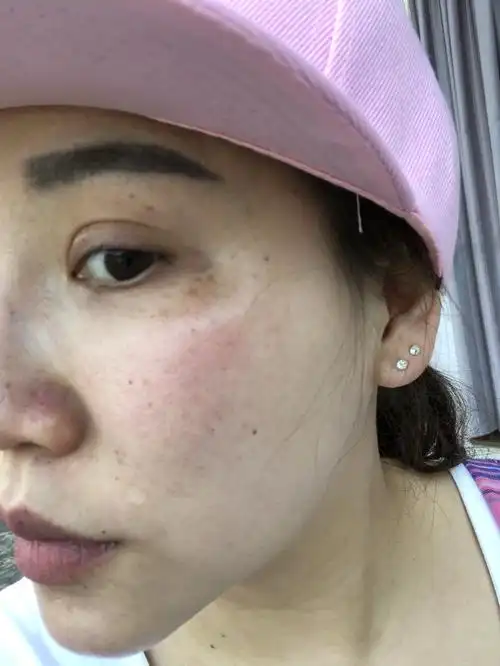 眼角下面长斑.皮肤暗黄 脸颊毛孔粗大.