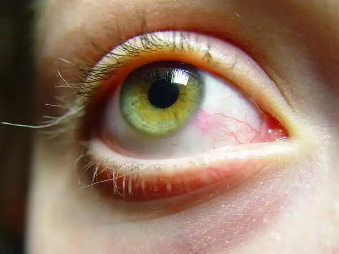 女人眼睛里的红色血丝