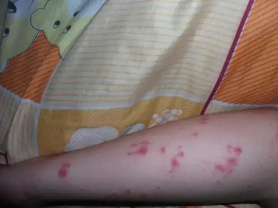 晚上睡觉时不知道是被什么虫子咬了,次日上午才知道,手臂上有好多红包