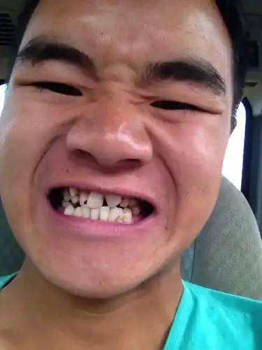 问:我牙齿挺难看的,我想戴牙套,请问要如何治疗?