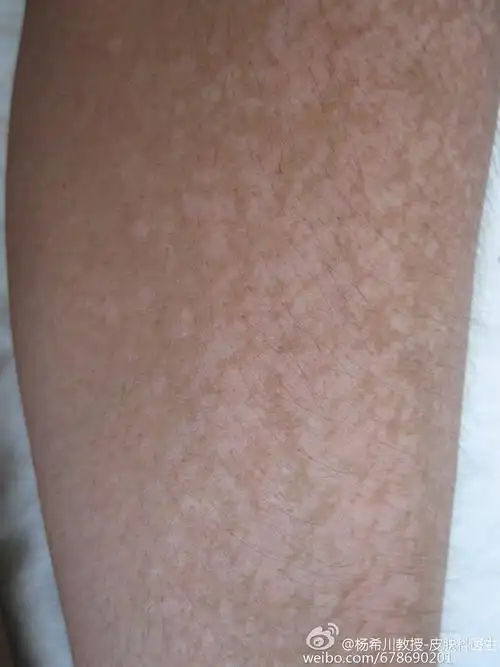 花斑癣的诊断及治疗》)      花斑癣: 发生于面部,由于经常擦洗