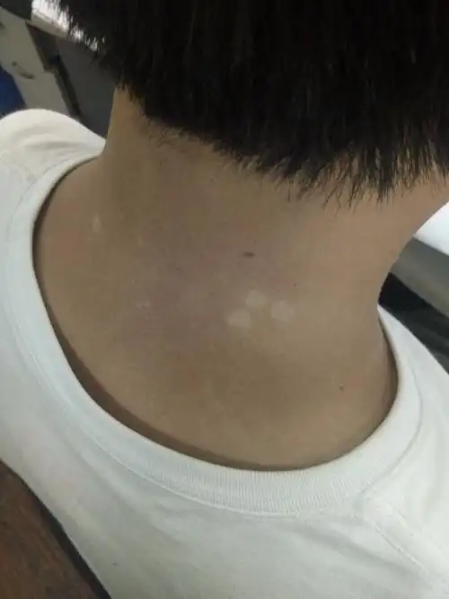 这是不是汗斑 还是白癜风急急急急