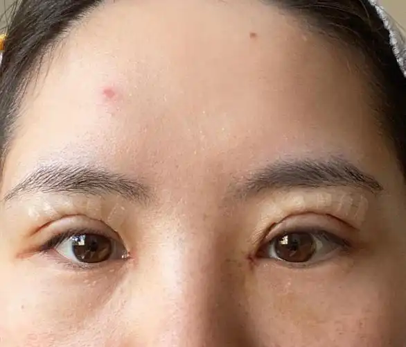 记录|终于割了双眼皮(肿眼泡)