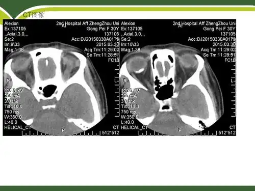 脉络膜骨瘤ppt课件