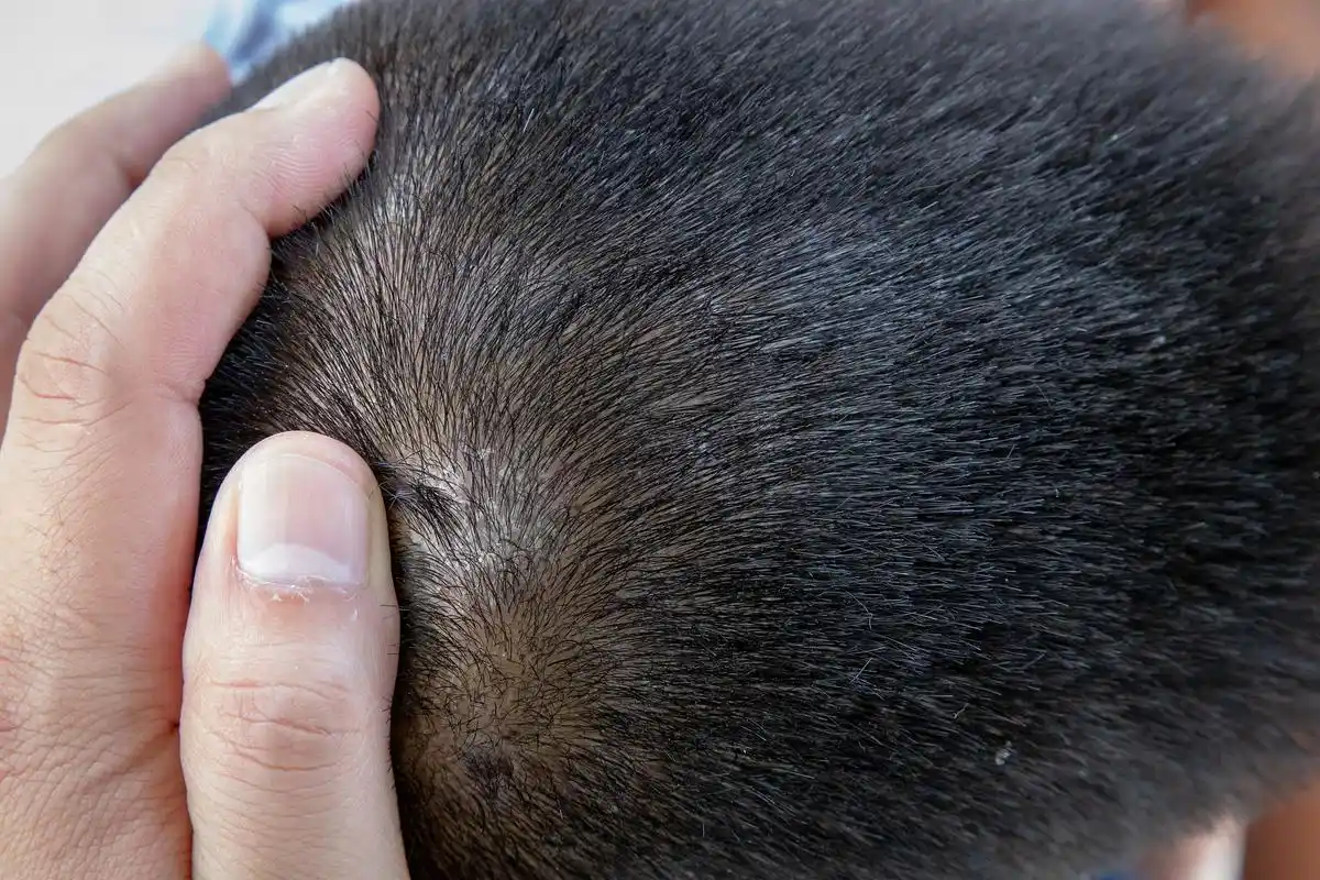 这种病症的症状包括头皮屑,头皮瘙痒,头发脱落等