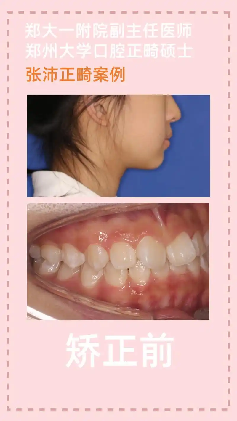 女孩牙列不齐,深覆合,上下牙齿中线均有偏斜,侧貌微突.进行近 - 抖音