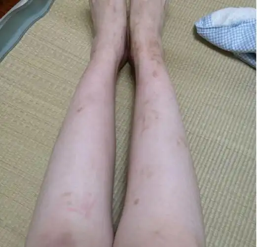 真心分享!从疤痕累积到光滑美皮只用这两招!轻松实现穿衣自由!