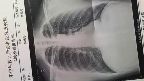 肺炎怎么治疗啊?