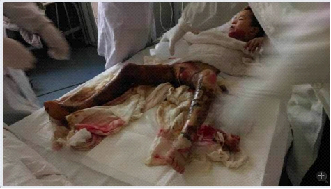 高海洋呼吁社会救助被烧伤的武汉6岁小朋友吴楚凡