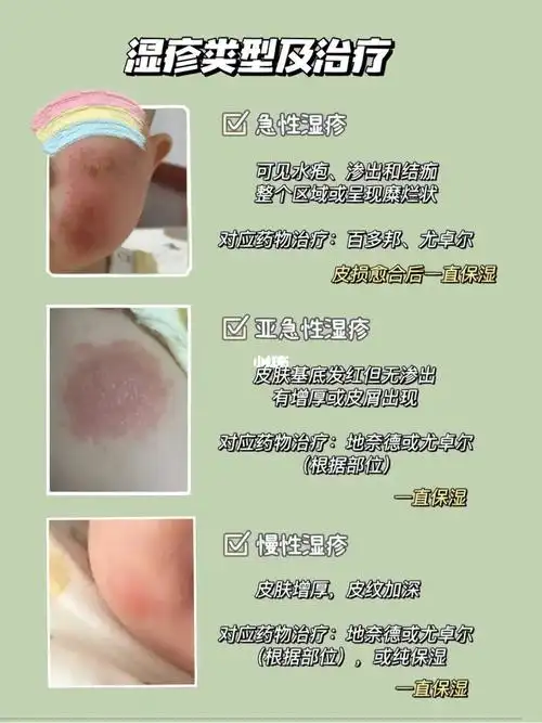 湿疹的宝宝该怎么办