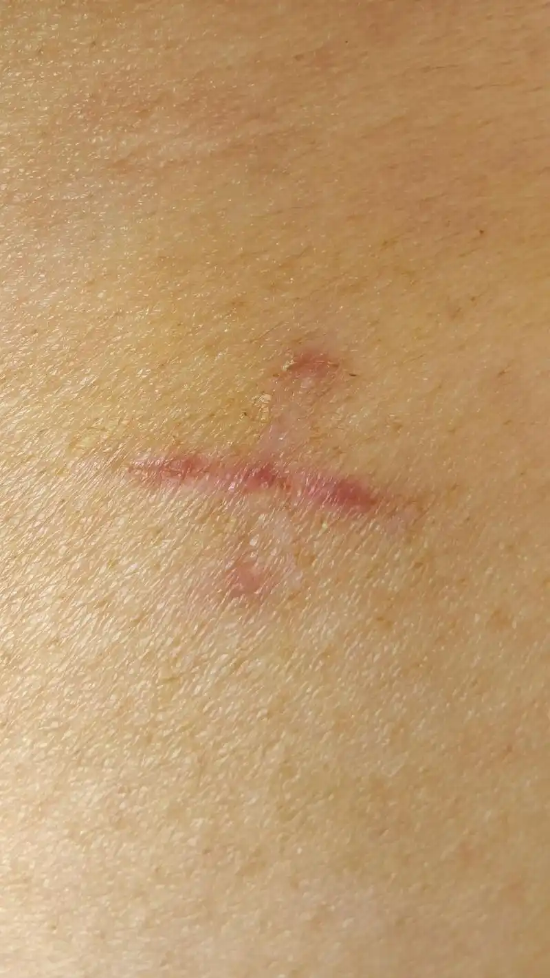 阑尾炎手术后24天,伤口右侧恢复得很好,左侧红肿疼痛,没有力 - 抖音