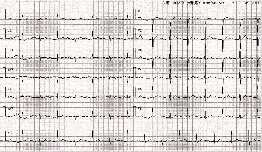 患者女,66岁,因突然晕厥就诊,图为其心电图结论:窦性心律一度房室传导