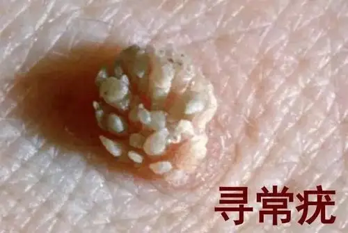 一个想打宫颈癌疫苗的直男