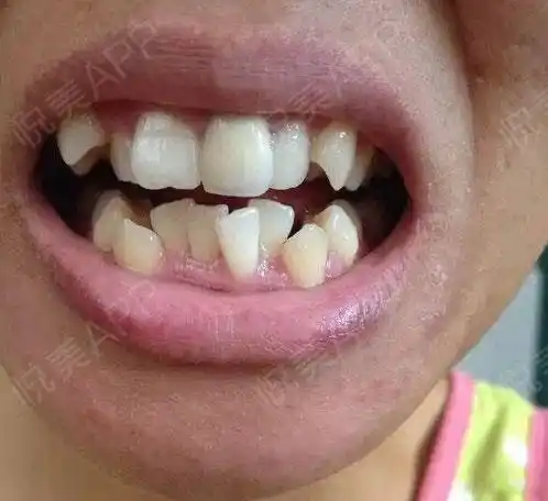 020202我的牙齿长得歪歪扭扭,下牙不齐,上面的牙齿能.