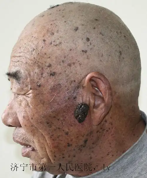 老年斑是怎么回事附图