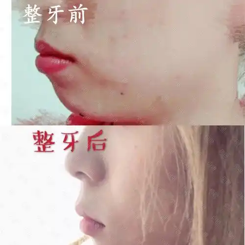 骨性龅牙的正畸矫正效果 个人感觉非常满意