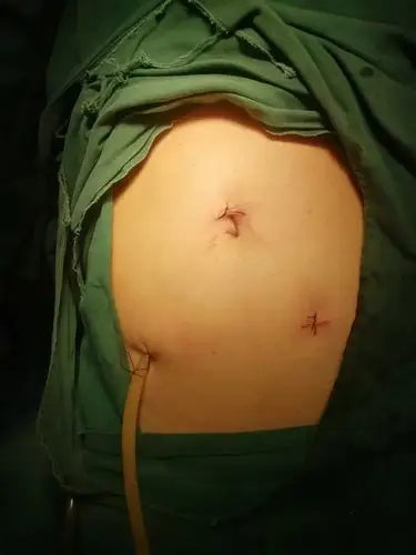 普外二科之——阑尾炎微创手术你了解吗?