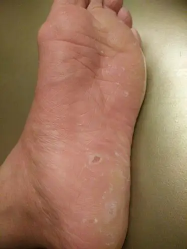 脚底有个洞,周围突起中间凹了个洞,平时走路有点痛,按着周围痛.