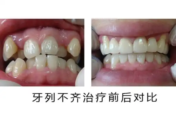 牙齿不齐不是天生就会有的